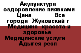 Акупунктура, оздоровление пиявками › Цена ­ 3 000 - Все города, Жуковский г. Медицина, красота и здоровье » Медицинские услуги   . Адыгея респ.